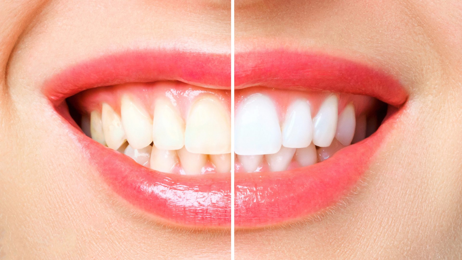 How to Naturally Whiten Your Teeth at Home