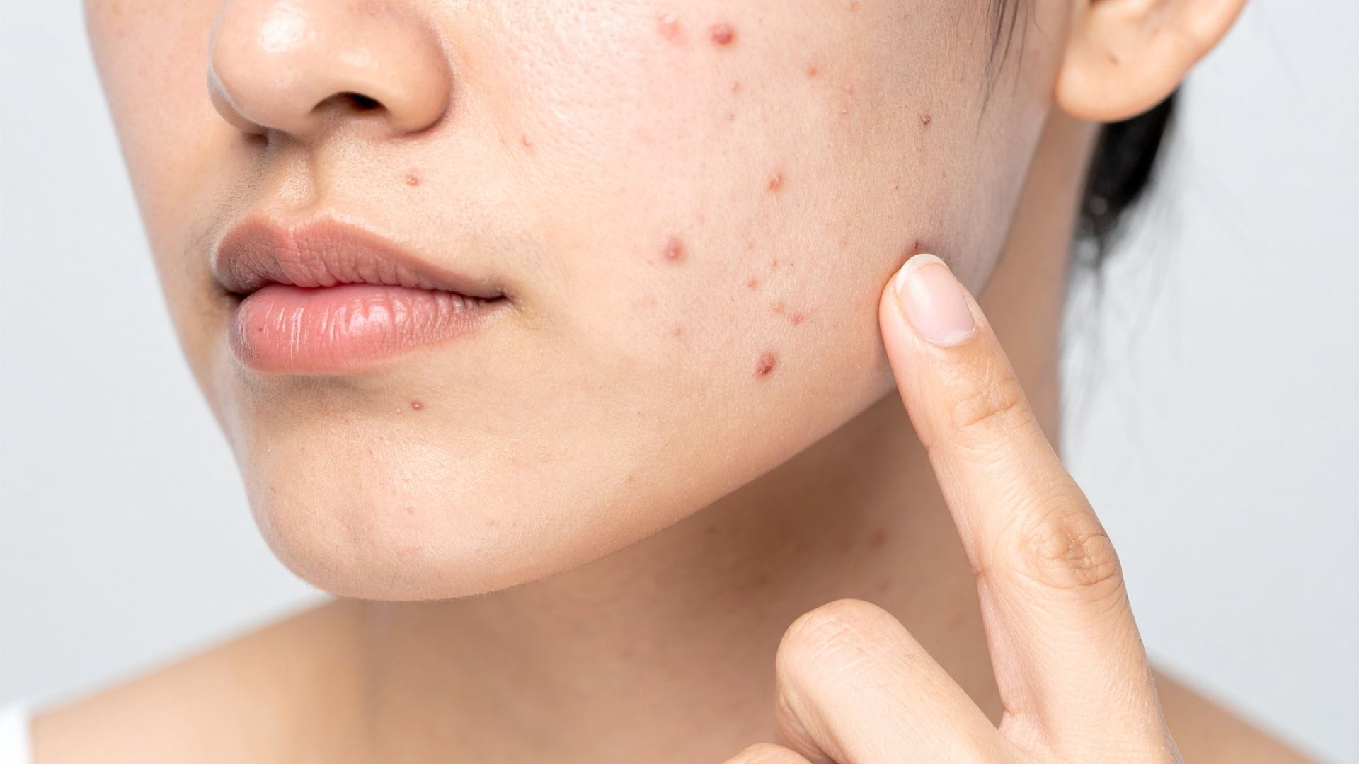 How to Remove Pimples Naturally in 7 Days: Complete Home Remedy Guide for Clear Skin