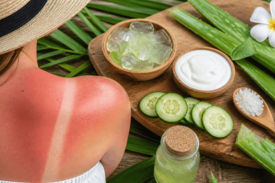 Natural Remedies for Sunburn and Skin Protection